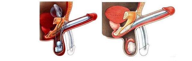 Prothesen zur Penisvergrößerung